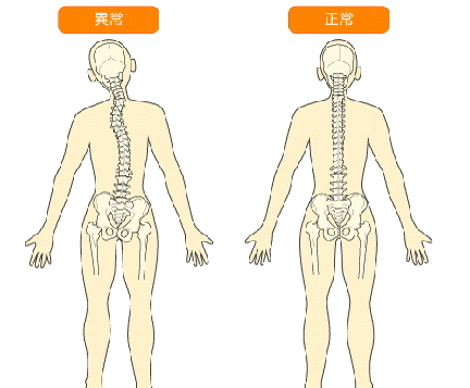 骨格の歪みイラスト