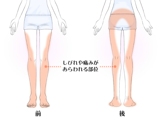 坐骨神経痛の症状部分のイラスト